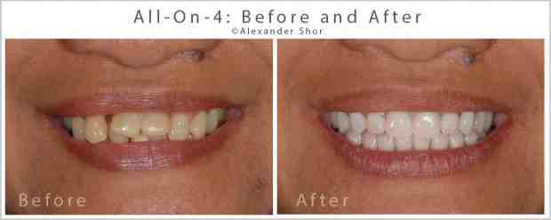 How long do all on 4 implants last?
