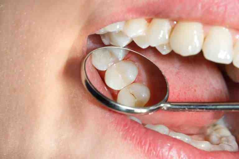 How long do composite veneers last?