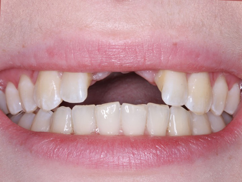 How long do dental implants last?