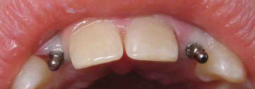 How long do mini dental implants last?