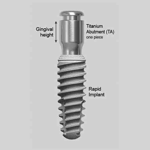 What is a titanium dental implant - Dental News Network