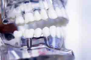 How long does a dental implant procedure take?
