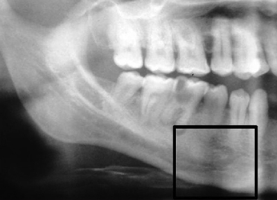 How long does a dental implant procedure take?