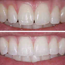 How long does dental bonding last on front teeth?