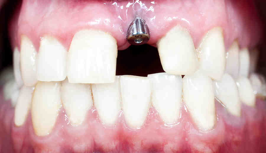 How long does it take for dental implants to settle?