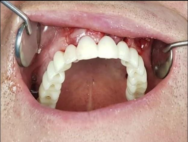 How long does it take for gums to heal after implants?