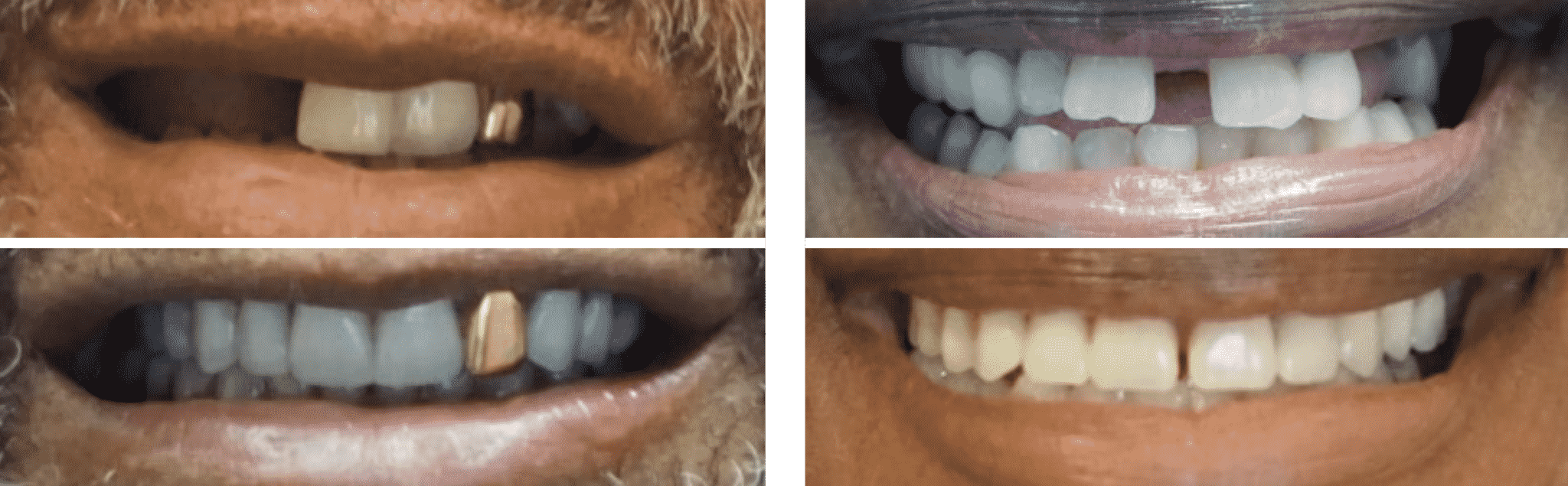How long does it take to get dental implants from start to finish?