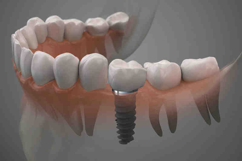 How long does pain last after tooth implant?