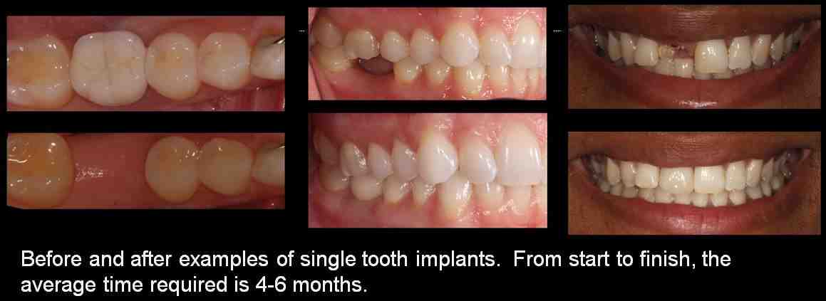 How long does the pain last after a dental implant?