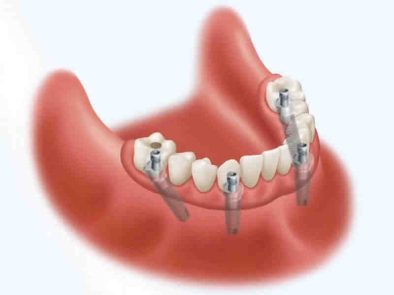 How many implants are needed for dentures?