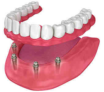 How many implants are needed for full mouth?