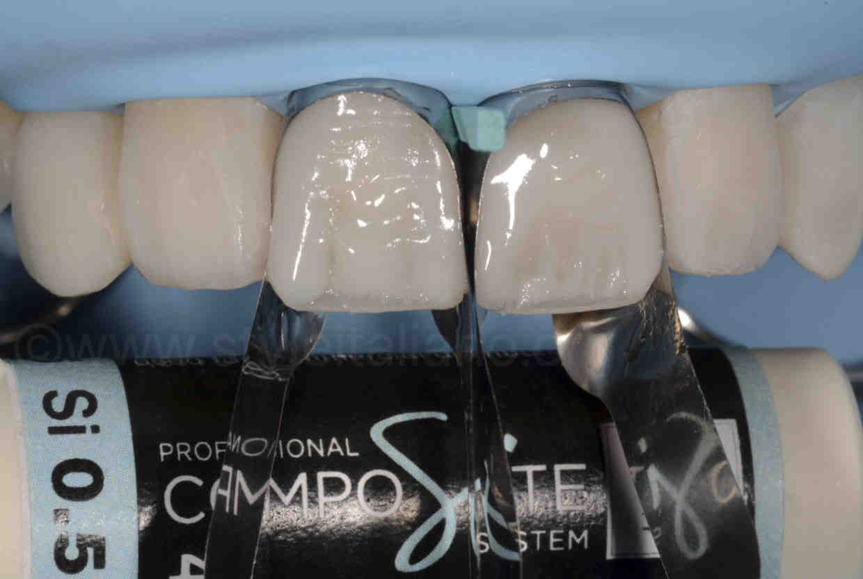 Cosmetic dentistry composite only Dental News Network