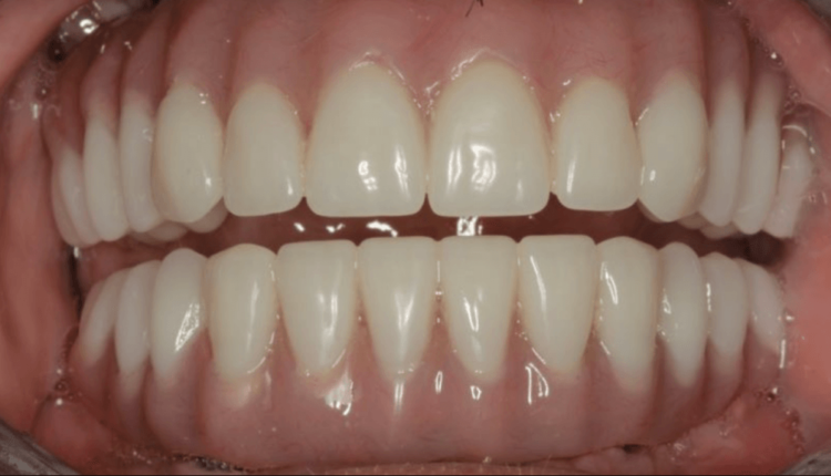 How much are dental implants for all teeth