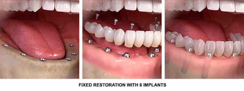 How much are dental implants in Australia?