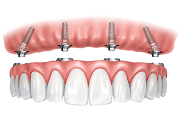 How much bone is needed for a dental implant?