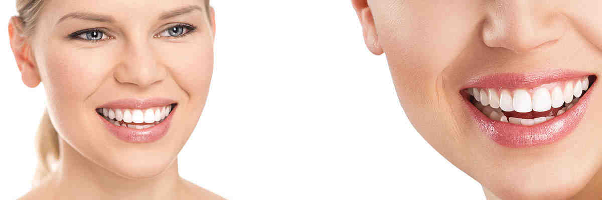 How much do cosmetic dental veneers cost?