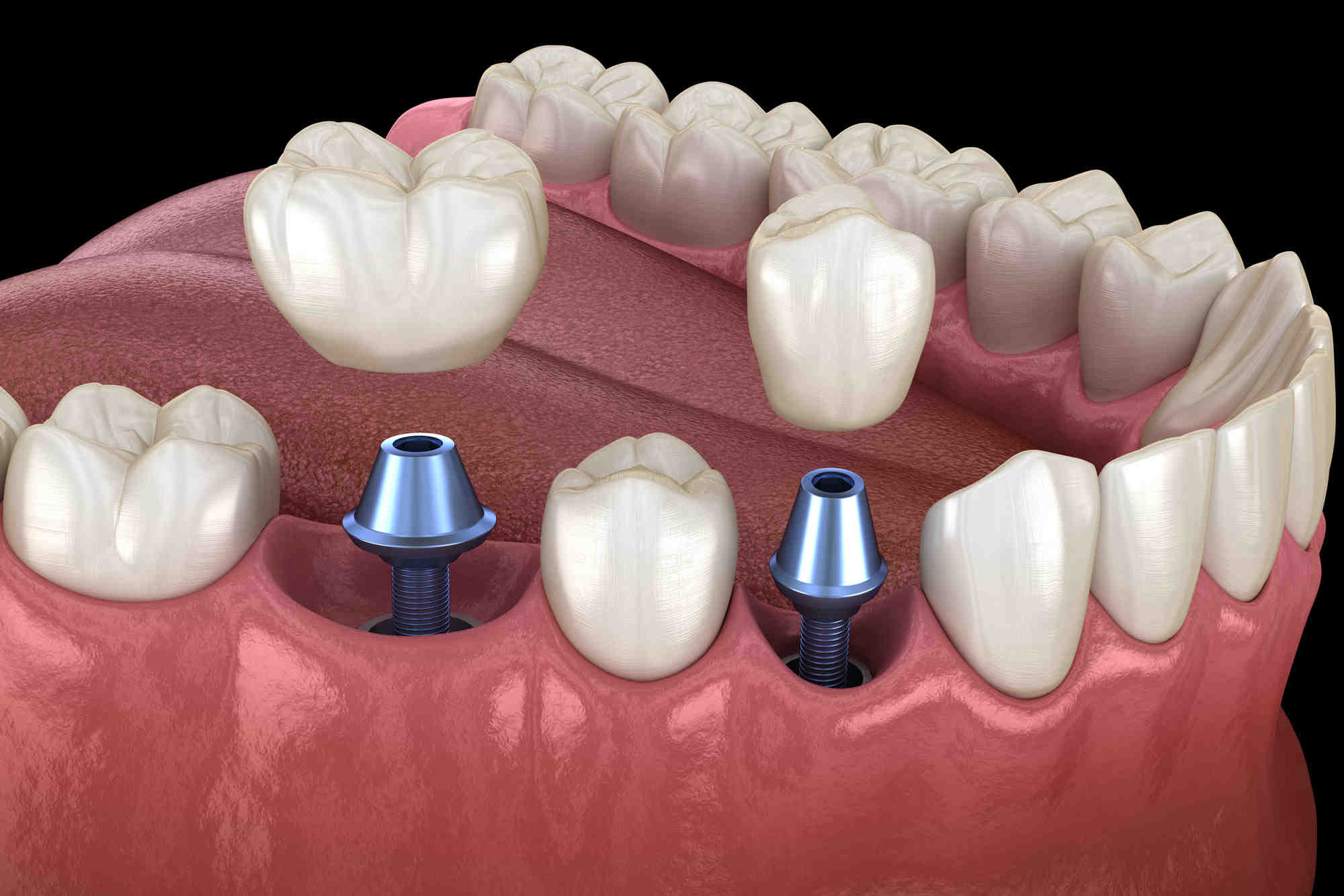 How much do dental implants cost in 2020?