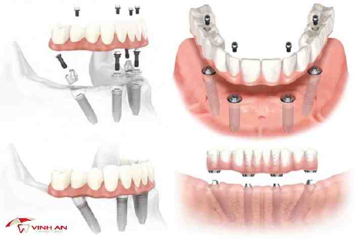 How much do dental implants cost in 2020?