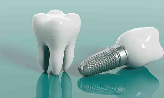 How much do dental implants cost in 2020?