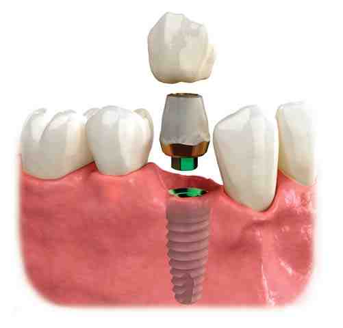 How much do dental implants cost in 2020?