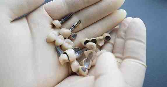 How much do dental implants cost in 2020?