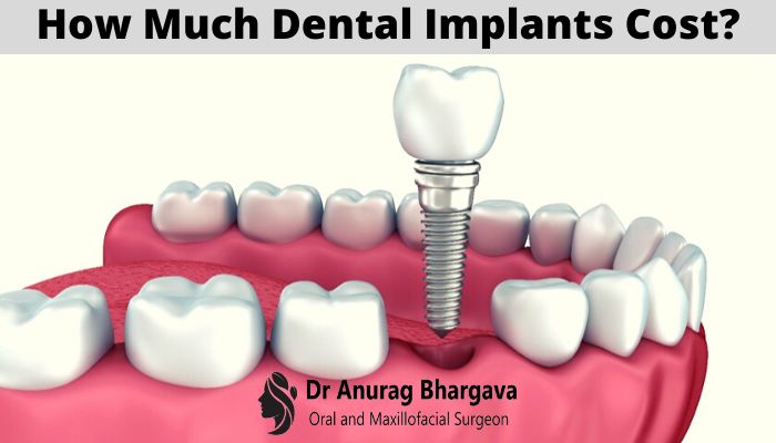 How much do dental implants cost in 2020?