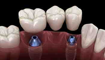How much do dental implants cost in Australia?