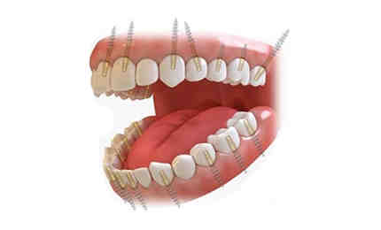 How much do dental implants cost in Australia?