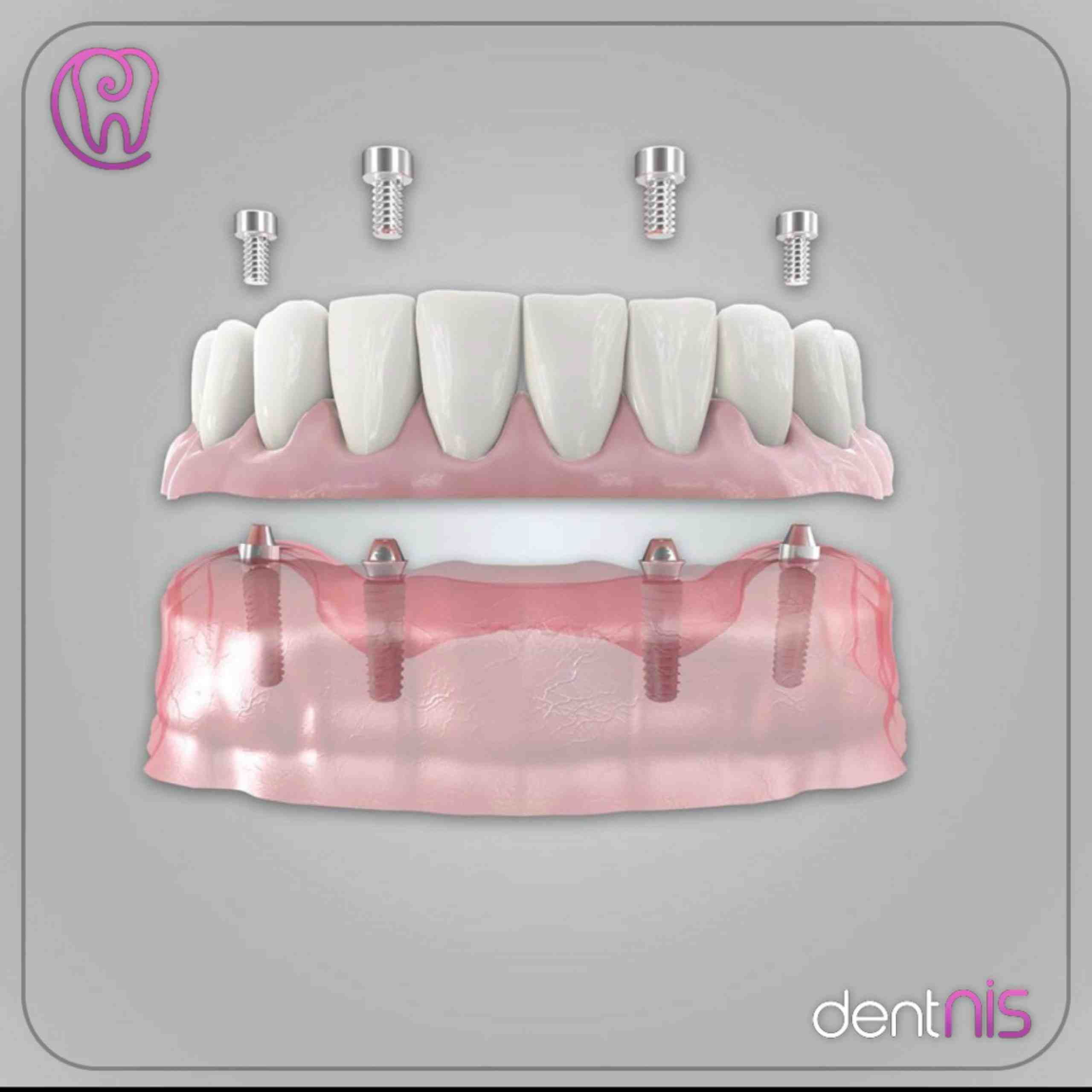 How much do dental implants cost in Australia?