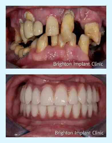 How much do dental implants cost in Australia?