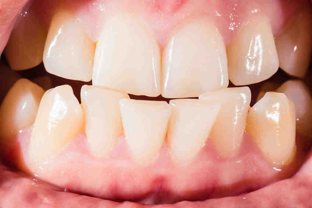 How much do dental implants cost in Springfield MO?