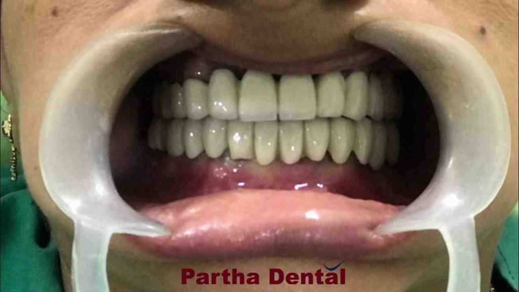 What is the cost of full dental implants Dental News Network