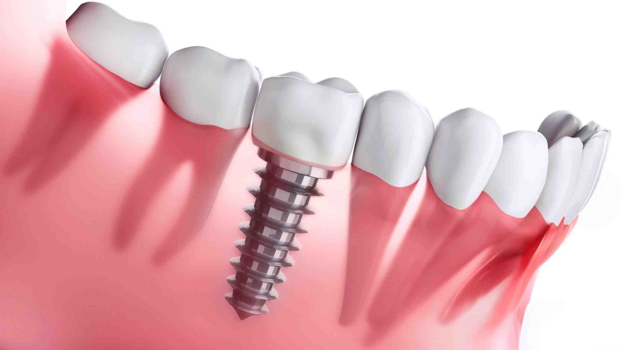 How Much Do Full Upper And Lower Dental Implants Cost 3 2048x1153 