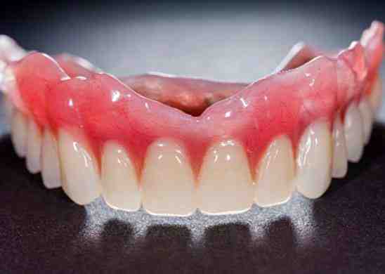 How much do full upper and lower dental implants cost?