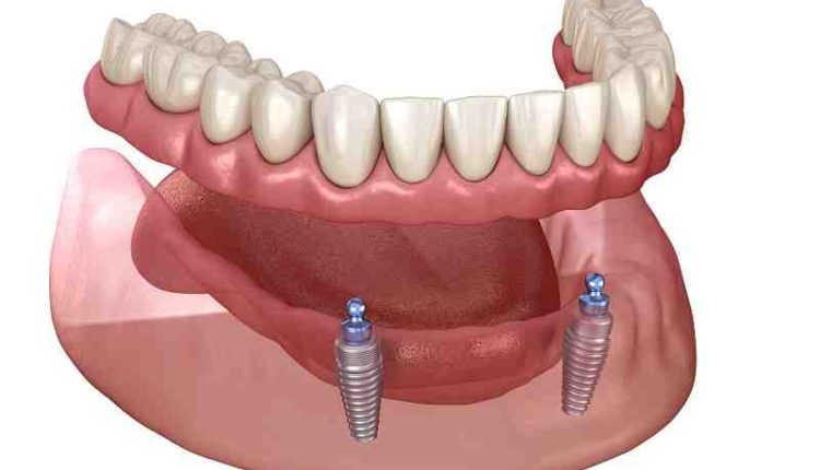 How much do mini dental implants cost