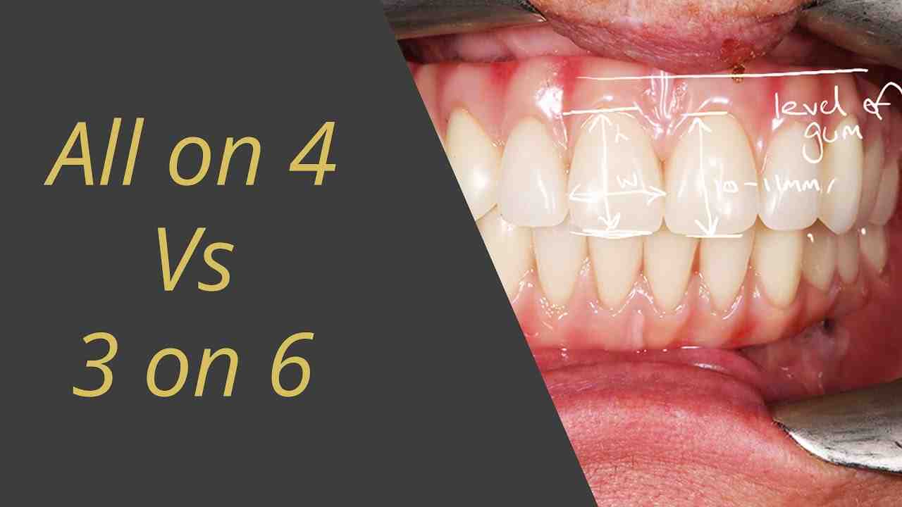 How much does 4 teeth implants cost?