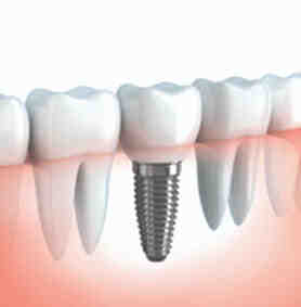 How much does Delta Dental cover for implants?