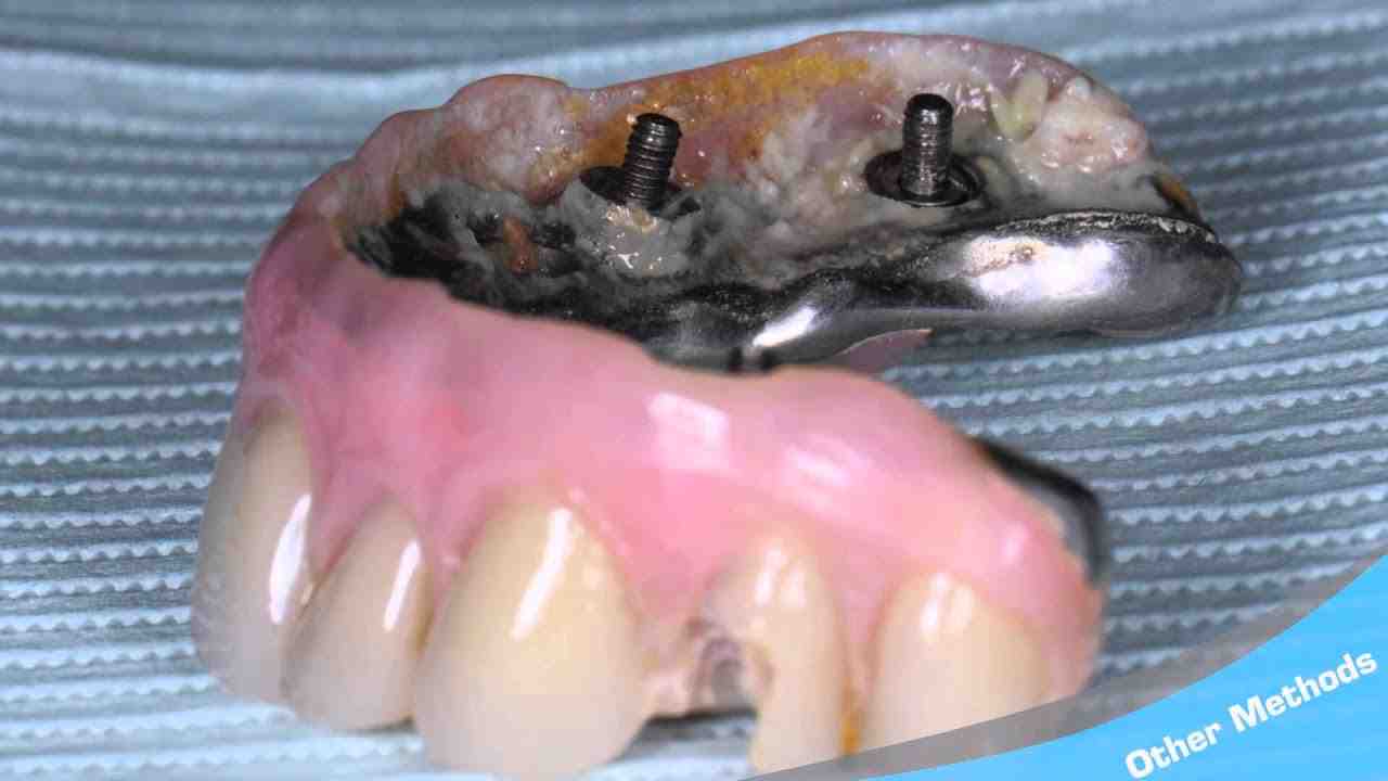 How much does a 4 in 1 dental implant cost?