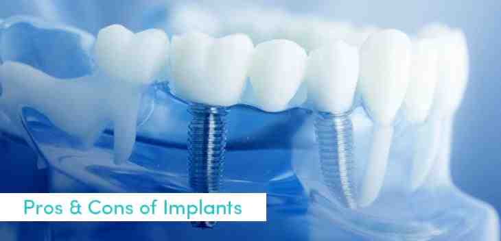How much does a dental implant cost for one tooth?