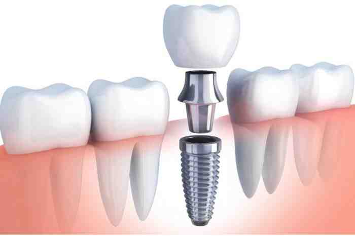 How much does a dental implant cost for one tooth?