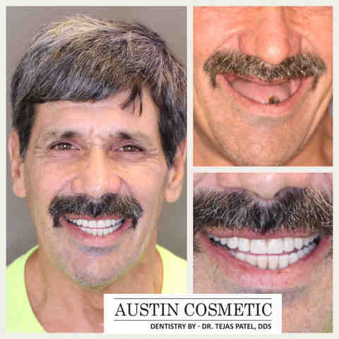 How much does a dental implant cost for one tooth?