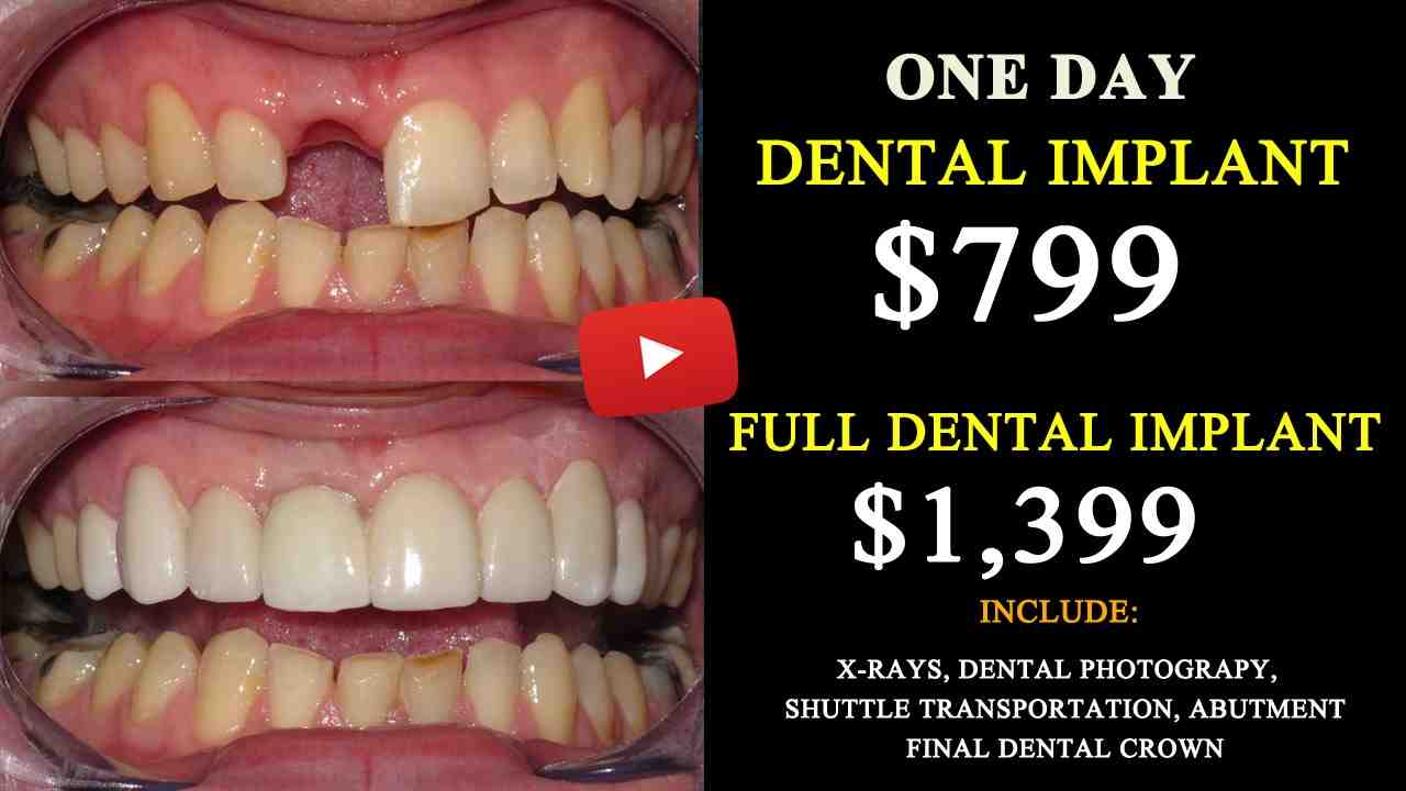 How much does a dental implant cost for one tooth with insurance?