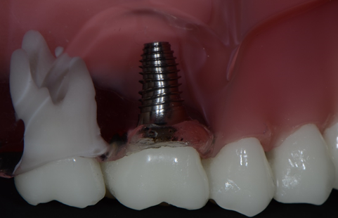 How much does a dental implant cost for one tooth?
