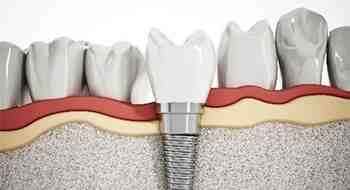 How much does a full set of dental implants cost?