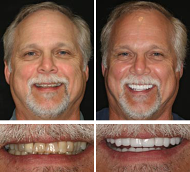 Cosmetic dentistry cost veneers - Dental News Network