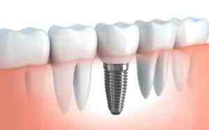 How much does a full upper implant cost?