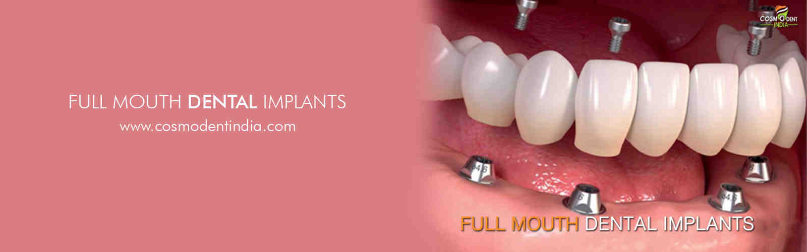 What is the cost of a dental implant Dental News Network