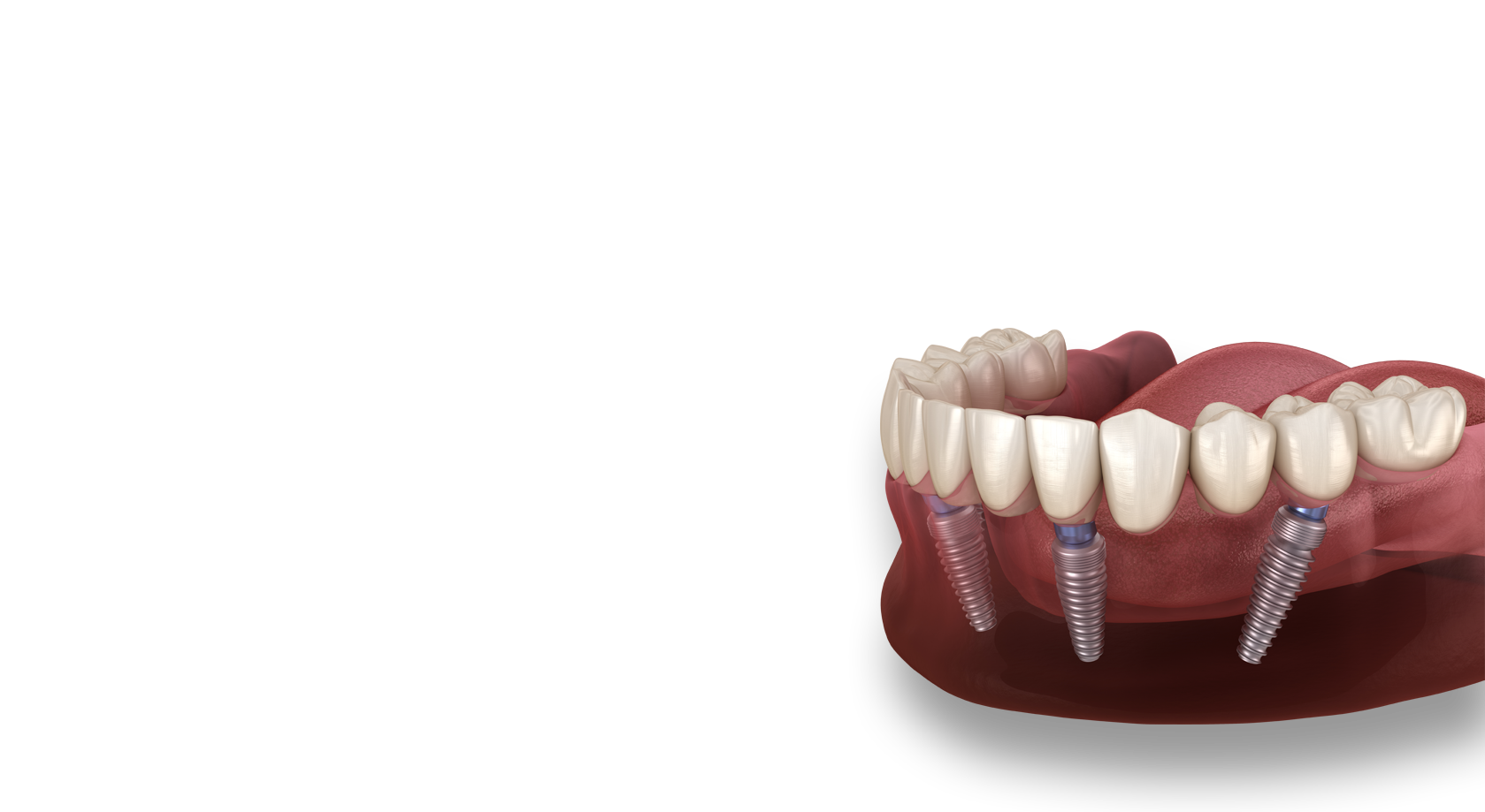 How much does all on four teeth cost?