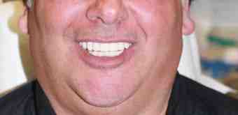 How much does clear choice cost for a full set of teeth?