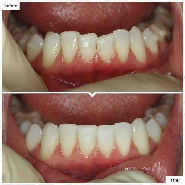 Cosmetic dentistry bonding before and after Dental News Network